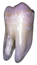 Extra Root Md First Molar.jpg